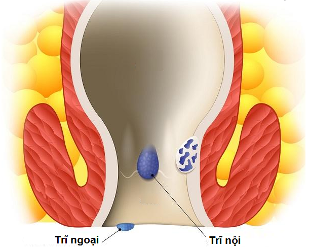 Bệnh trĩ là gì?